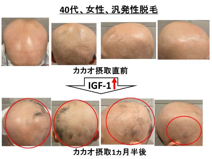 円形脱毛症　病院